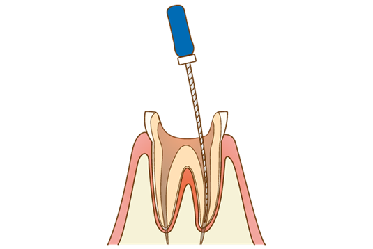虫歯・神経の除去